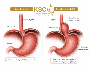 فتق الحجاب الحاجز